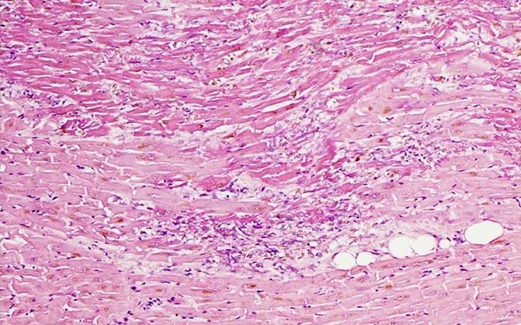 Histologischer Schnitt, HE-Färbung: Herzmuskelfasern mit verstärkt eosinophilem Zytoplasma und eingestreuten Entzündungszellen