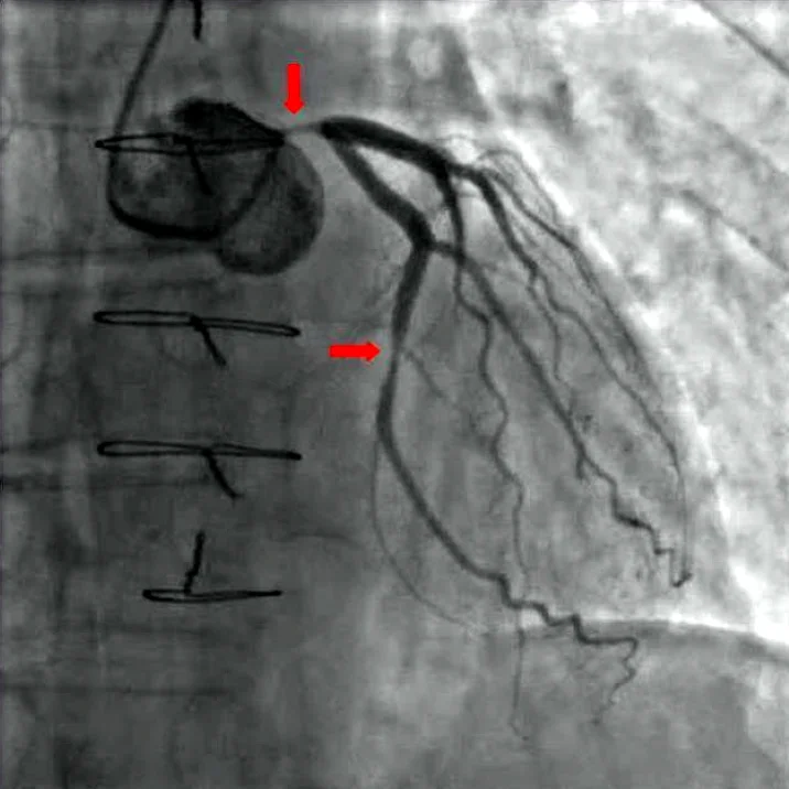 Koronarangiographie der linken Koronararterie; zwei rote Pfeile zeigen auf hochgradige Engstellen am Hauptstamm und am Ramus circumflexus