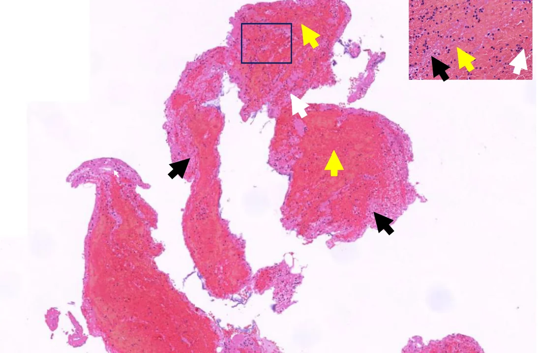 Lichtmikroskopischer Schnitt eines frischen, aus einer Koronararterie abgesaugten Thrombus in Hämatoxylin-Eosin-Färbung mit Pfeilen auf Fibrin, Erythrozyten und Leukozyten; oben rechts eine vergrößerte Ausschnittsvergrößerung