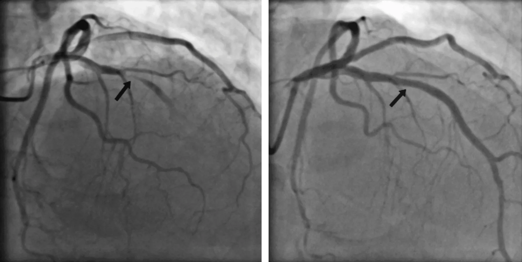 Zwei Koronarangiographien der linken Koronararterie: links Totalverschluss der mittleren RIVA mit Pfeil, rechts dasselbe Gefäß nach PCI wieder durchgängig kontrastiert