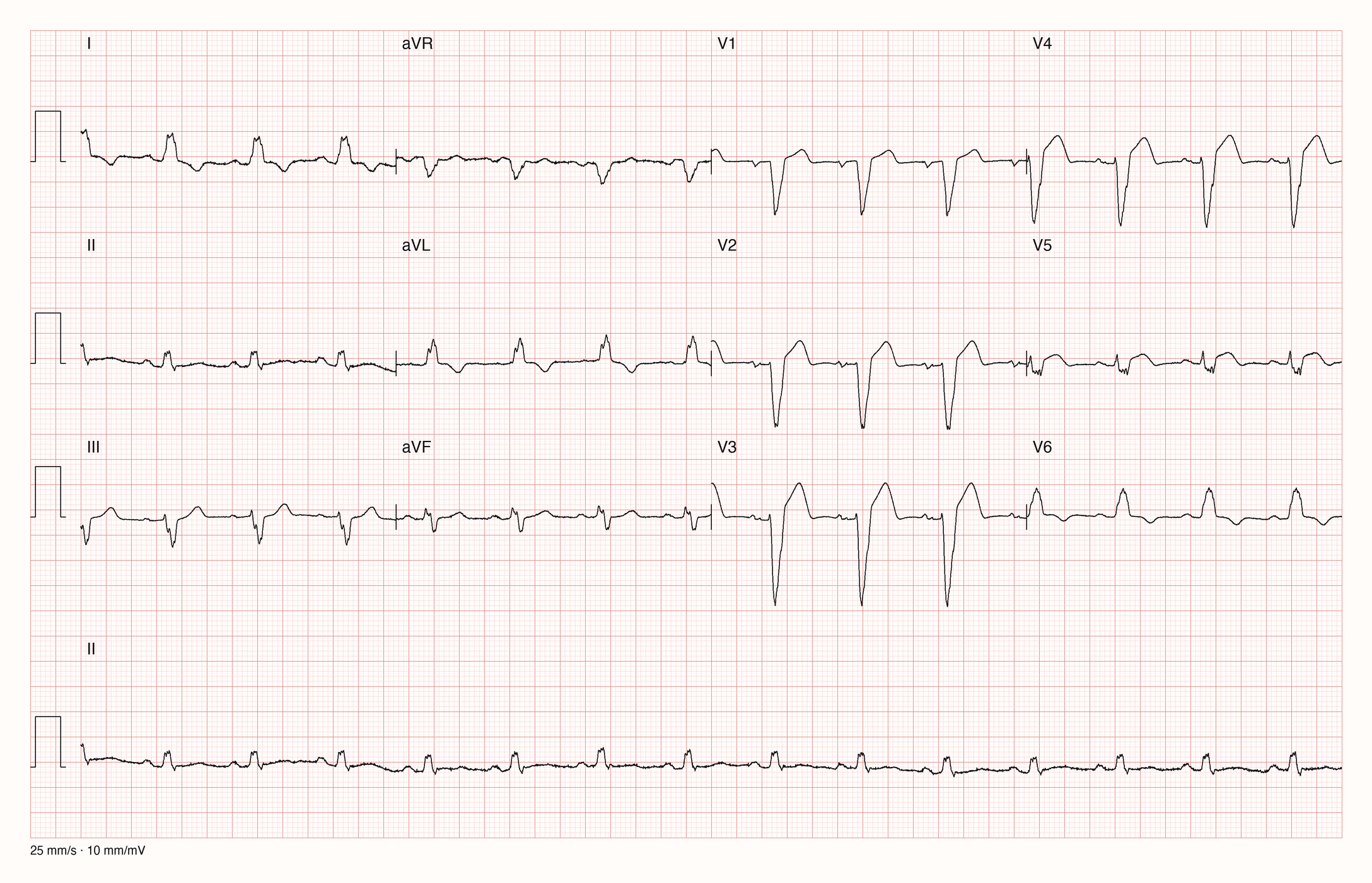 Reale EKG-Aufzeichnung mit zwölf Ableitungen; Aufnahme C03-U19-Q03; Skalierung im Bild