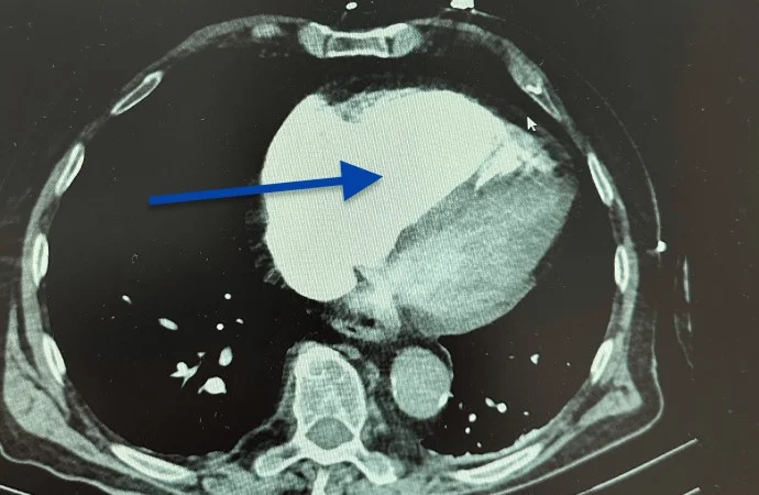 Axiale kontrastmittelgestützte CT des Thorax auf Höhe der Herzkammern: stark erweiterter, hell kontrastierter rechter Ventrikel vorn, kleinerer linker Ventrikel dahinter, blauer Pfeil auf den rechten Ventrikel