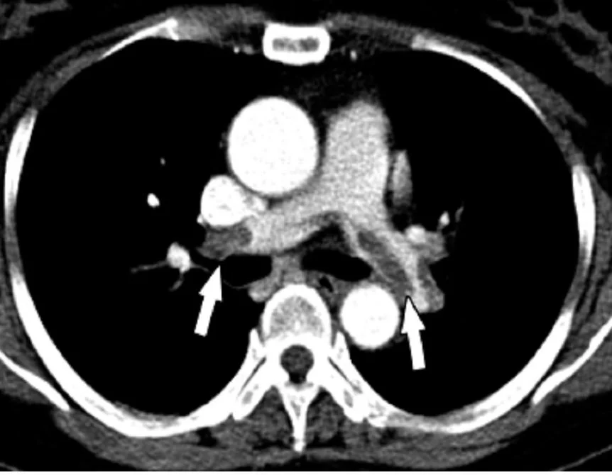 Axiale CT-Pulmonalisangiografie: hell kontrastierte Pulmonalarterien mit dunklen Aussparungen in Pulmonalarterienästen beider Seiten, zwei weiße Pfeile