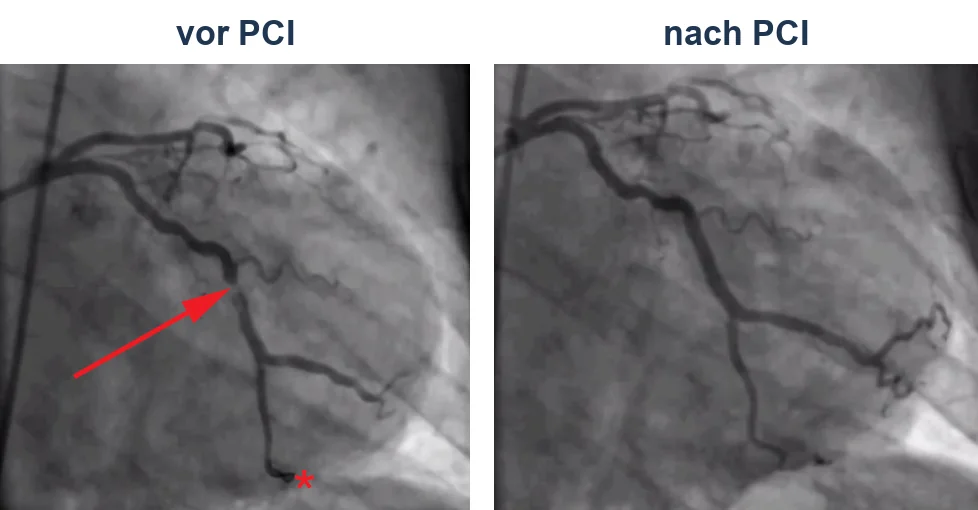 Koronarangiografie des linken Koronarsystems derselben Person vor und nach PCI