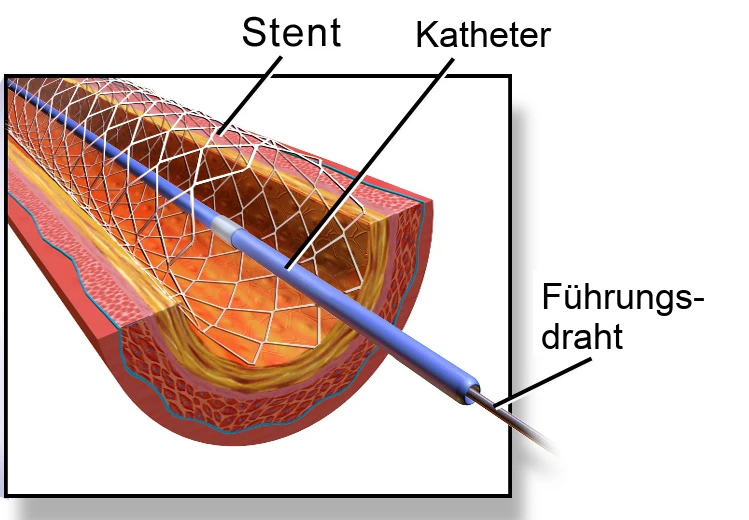 Illustration eines Stents im aufgeschnittenen Herzkranzgefäß mit Katheter und Führungsdraht