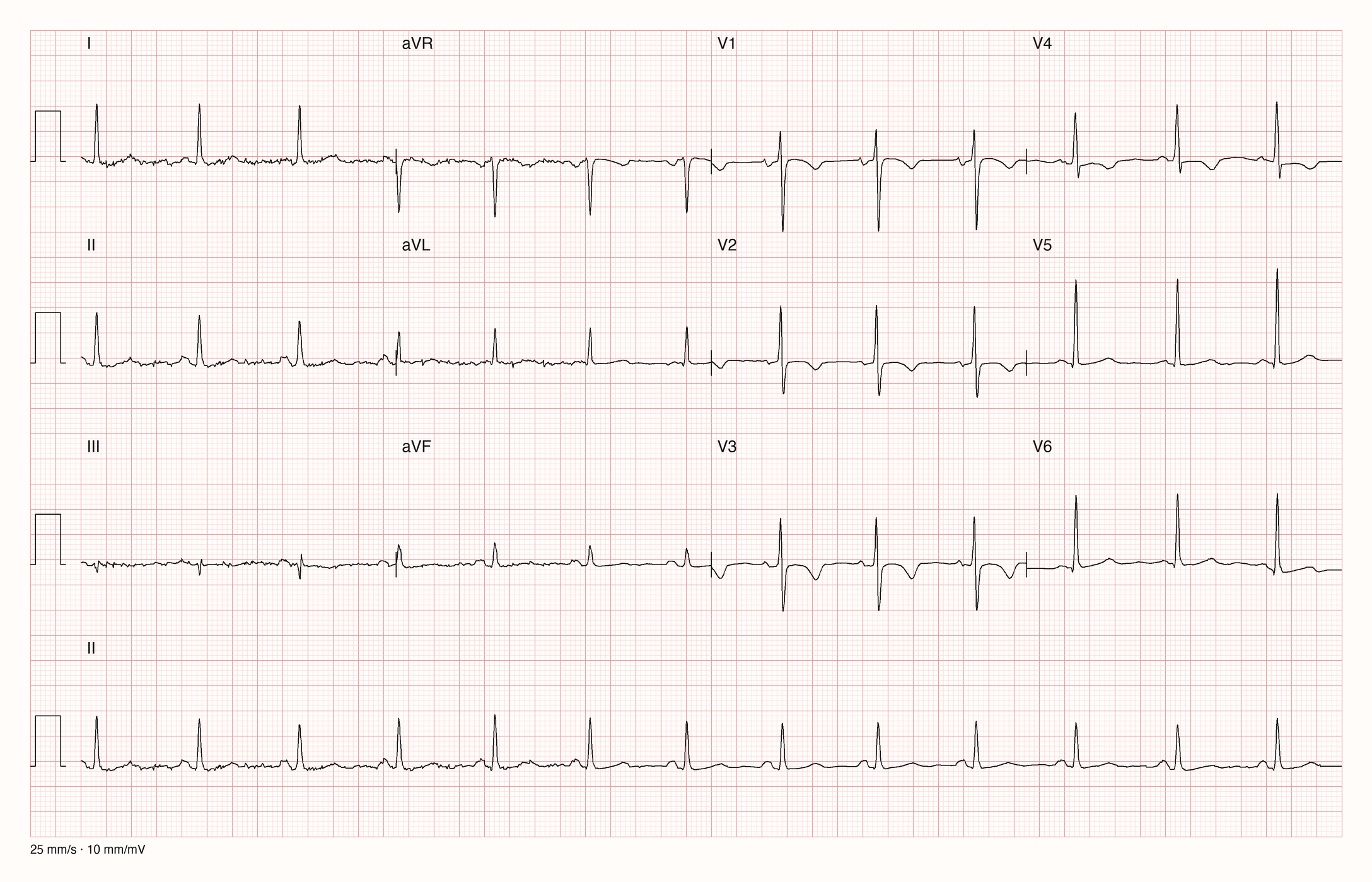 Reale EKG-Aufzeichnung mit zwölf Ableitungen und Rhythmusstreifen II; Pool-Aufnahme 904; Skalierung im Bild