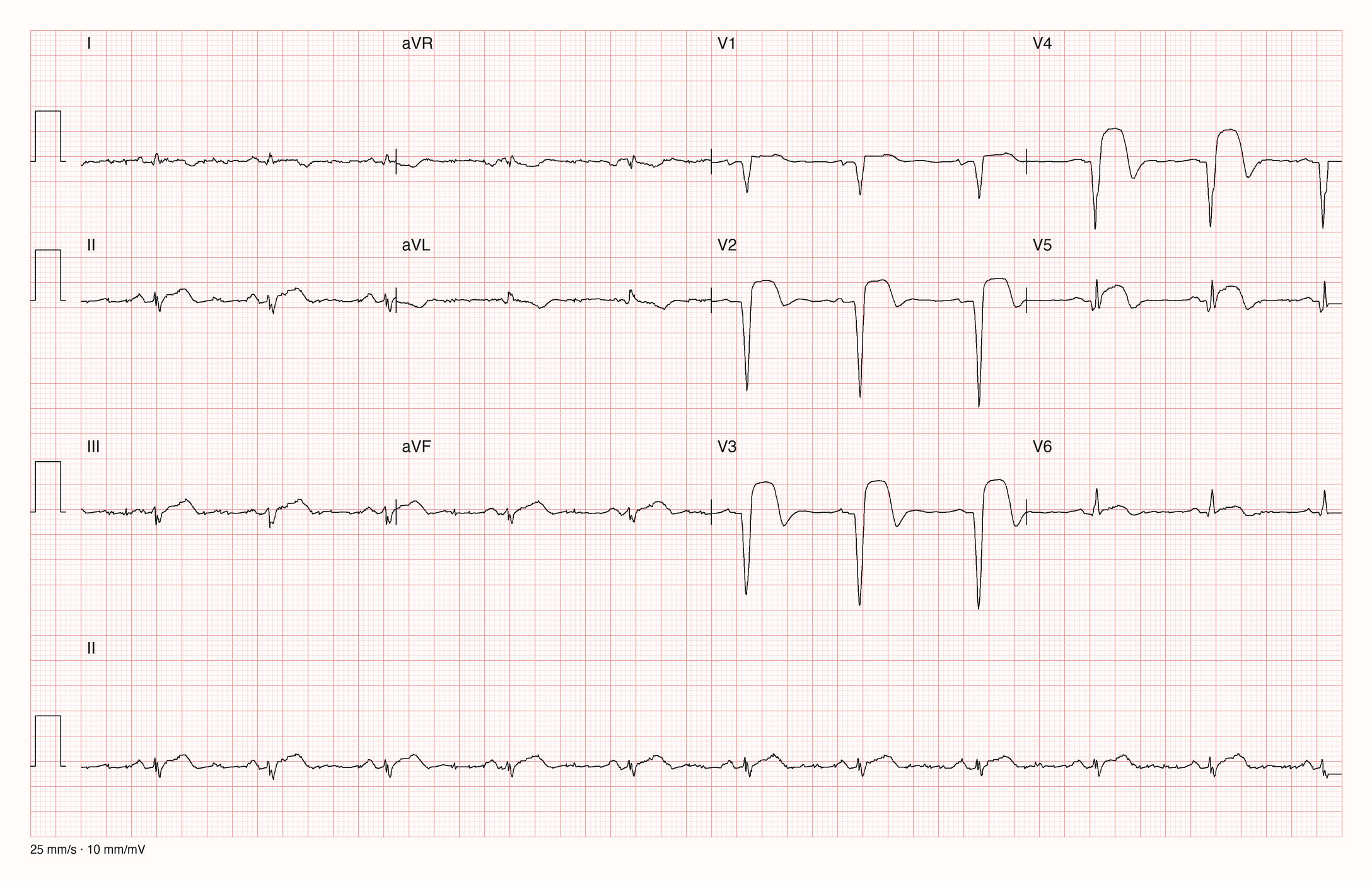 Reale EKG-Aufzeichnung mit zwölf Ableitungen und Rhythmusstreifen II; Pool-Aufnahme 905; Skalierung im Bild