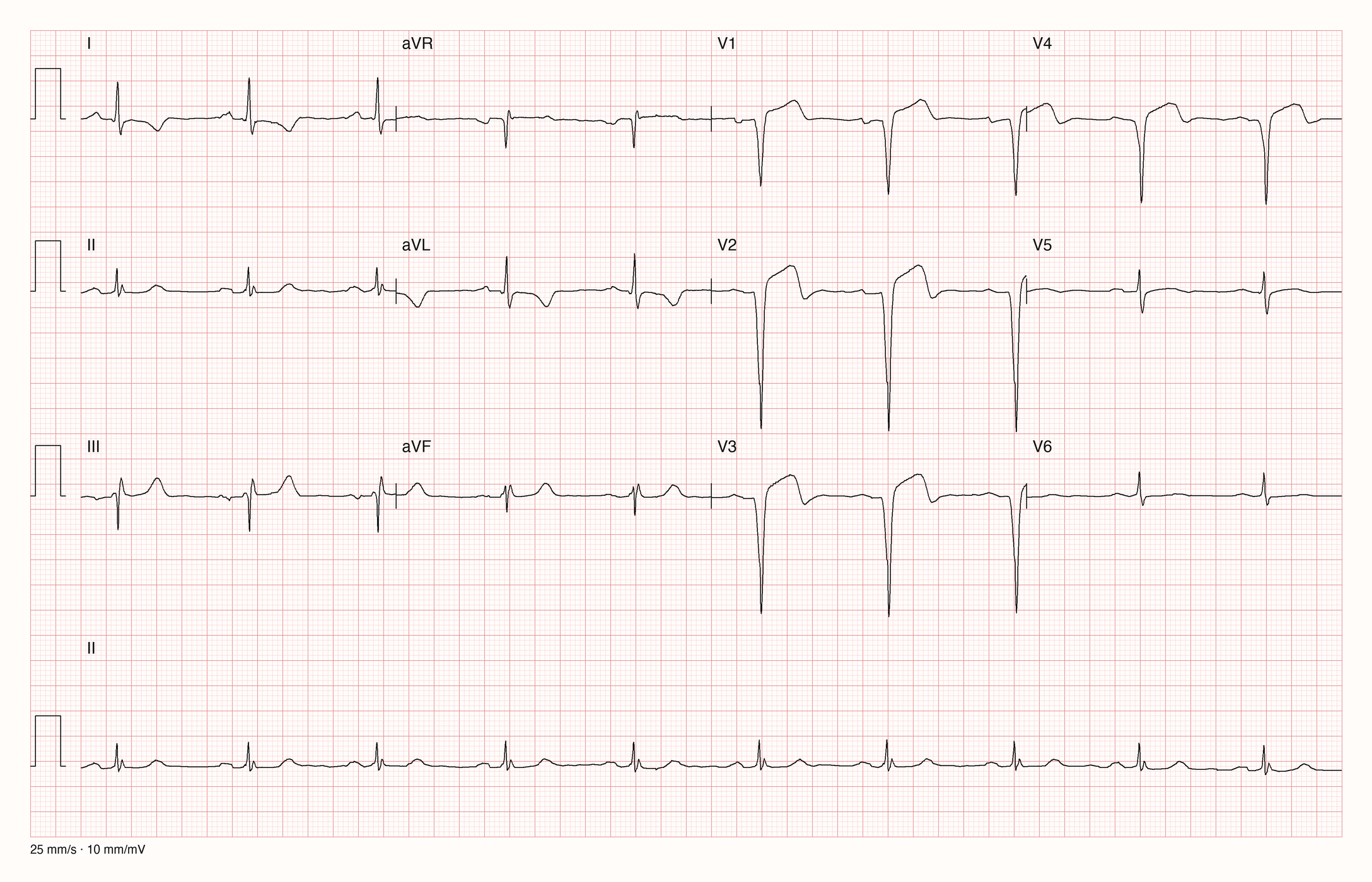 Reale EKG-Aufzeichnung mit zwölf Ableitungen und Rhythmusstreifen II; Pool-Aufnahme 906; Skalierung im Bild