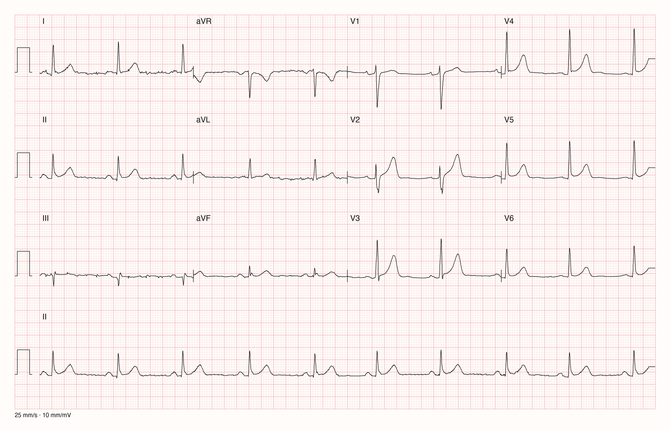 Reale EKG-Aufzeichnung mit zwölf Ableitungen und Rhythmusstreifen II; Pool-Aufnahme 921; Skalierung im Bild