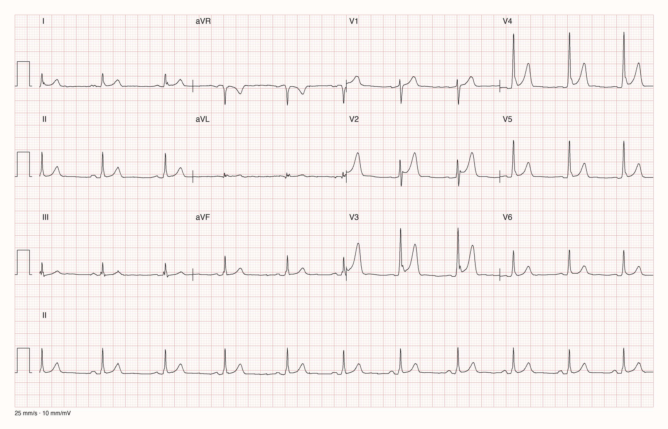 Reale EKG-Aufzeichnung mit zwölf Ableitungen und Rhythmusstreifen II; Pool-Aufnahme 922; Skalierung im Bild