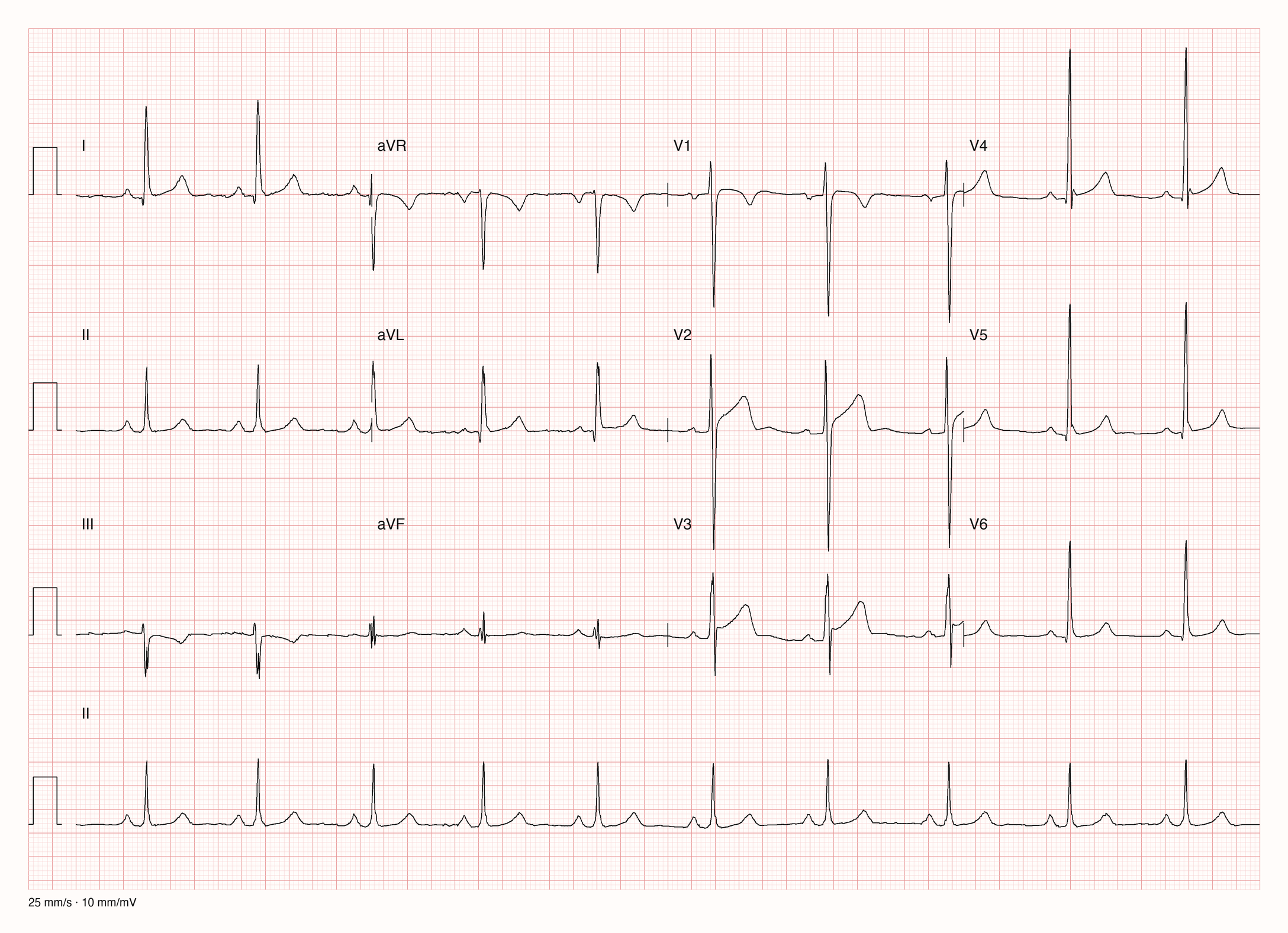 Reale EKG-Aufzeichnung mit zwölf Ableitungen und Rhythmusstreifen II; Pool-Aufnahme 924; Skalierung im Bild