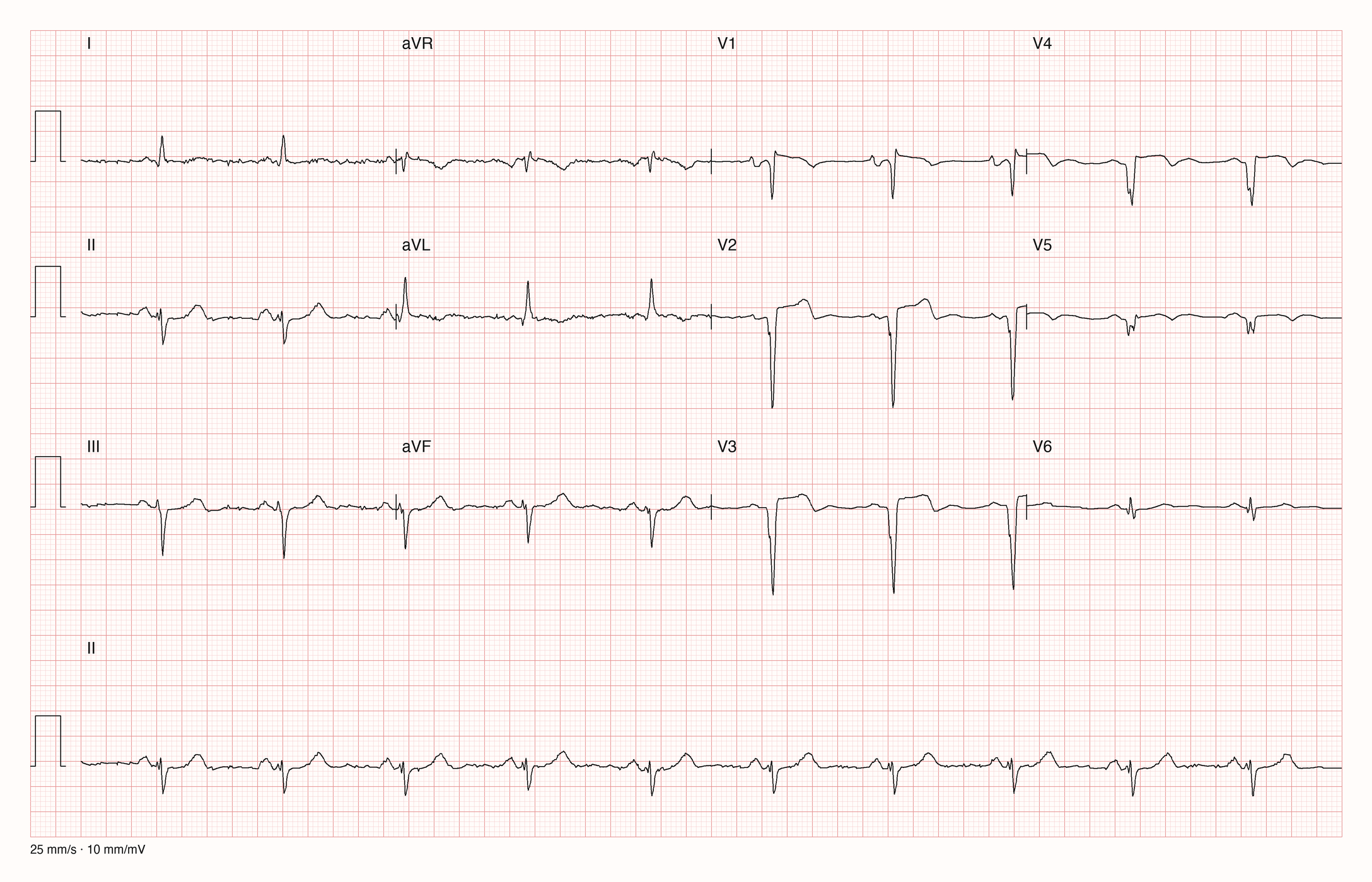 Reale EKG-Aufzeichnung mit zwölf Ableitungen und Rhythmusstreifen II; Pool-Aufnahme 930; Skalierung im Bild