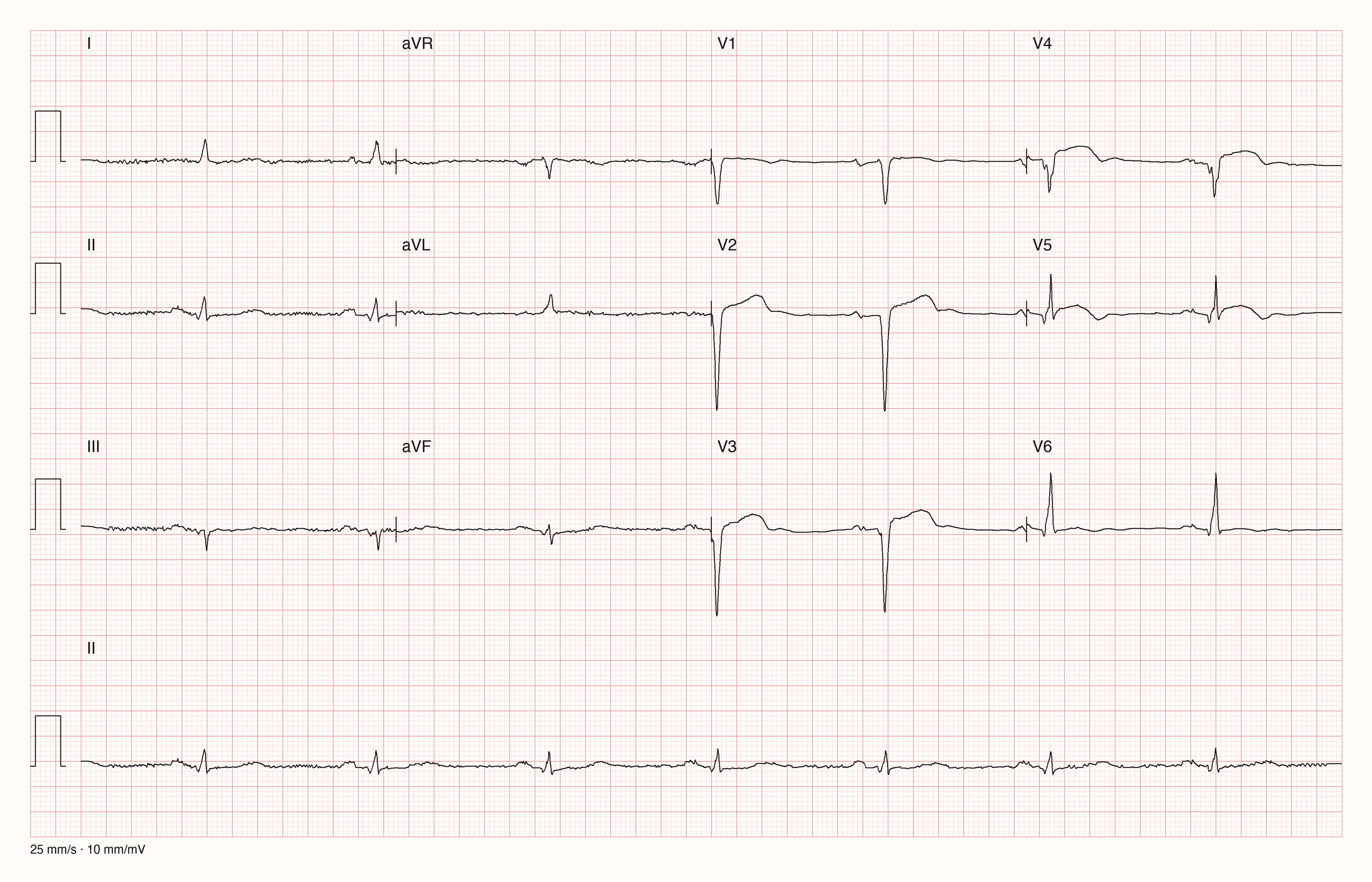 Reale EKG-Aufzeichnung mit zwölf Ableitungen und Rhythmusstreifen II; Pool-Aufnahme 931; Skalierung im Bild
