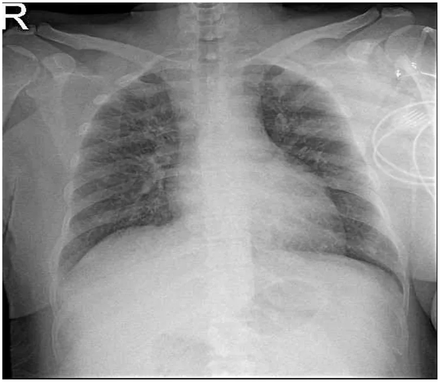 Röntgen-Thorax a.-p.: beidseits vermehrte, unscharf begrenzte Lungenzeichnung bis in die Peripherie mit verdichteten Hili, rechts im Bild EKG-Kabel; oben links Seitenbuchstabe R