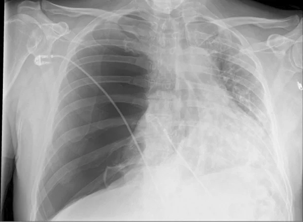 Thorax-Röntgen a.p.: rechte Thoraxhälfte dunkel ohne Lungengefäßzeichnung mit zusammengefallener Lunge am Hilus, Herz und Mediastinum nach links verlagert