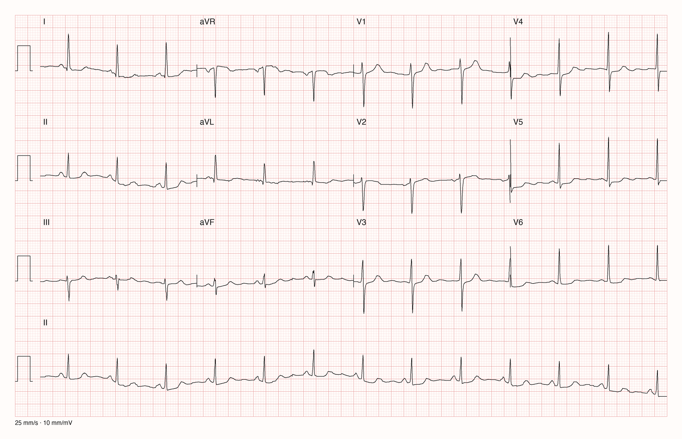 Reale EKG-Aufzeichnung mit zwölf Ableitungen; Aufnahme C03-U18-Q02; Skalierung im Bild