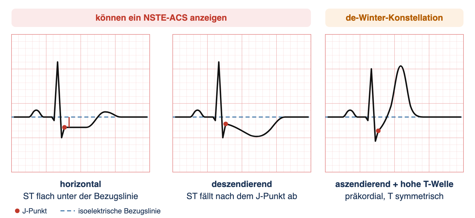 Drei schematische Herzzyklen auf EKG-Raster: horizontale ST-Senkung, deszendierende ST-Senkung mit negativer T-Welle und aszendierende ST-Senkung mit hoher symmetrischer T-Welle; J-Punkt jeweils rot markiert