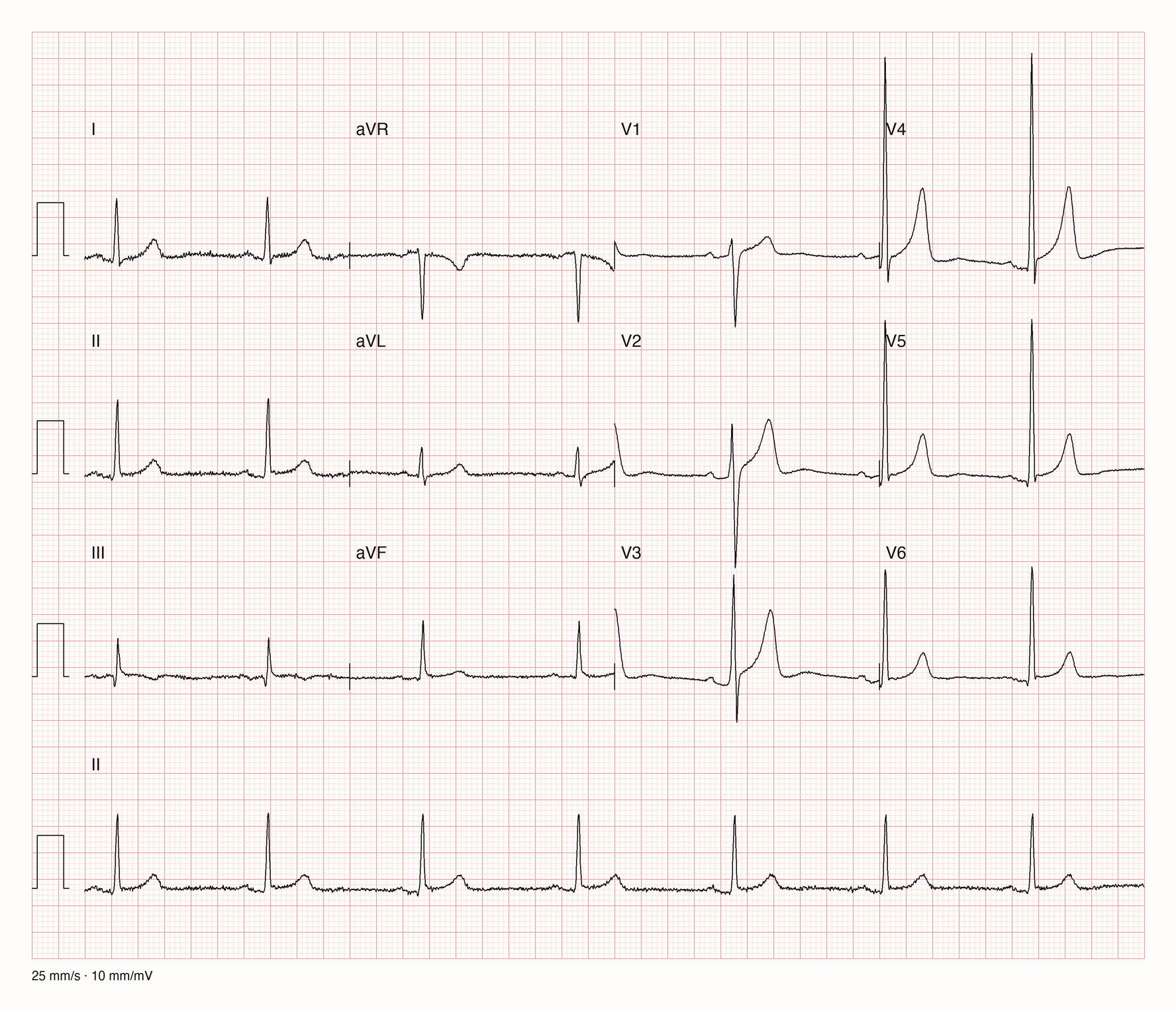 Reale EKG-Aufzeichnung mit zwölf Ableitungen; Aufnahme C03-U19-Q02; Skalierung im Bild