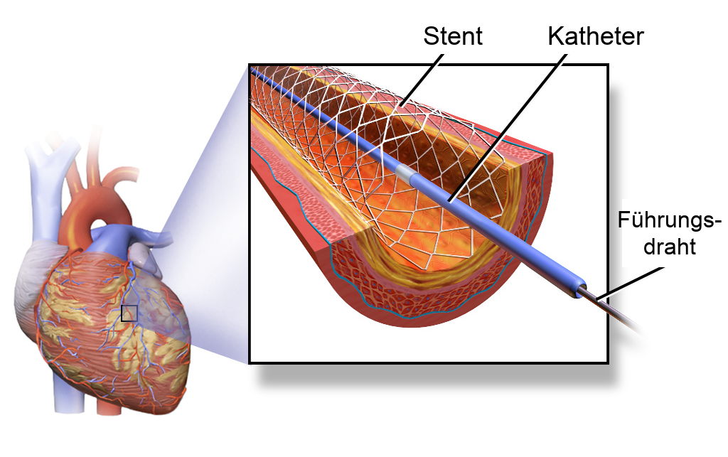 Zeichnung eines Herzens mit vergrößertem Ausschnitt einer Koronararterie, in der ein Stent über Katheter und Führungsdraht eingebracht ist