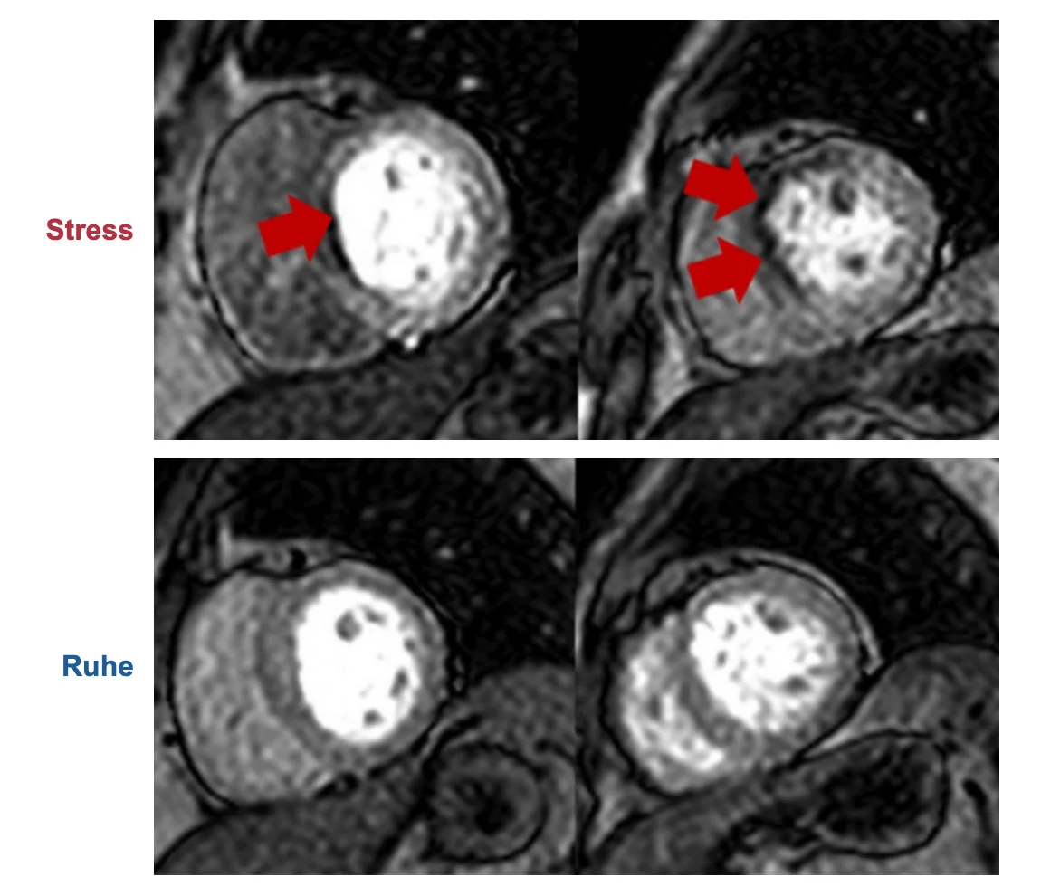 Stress-Perfusions-MRT in zwei Kurzachsenschnitten: unter Stress dunkle subendokardiale Zone im basalen Septum und anteroseptal (rote Pfeile), in Ruhe gleichmäßige Kontrastierung