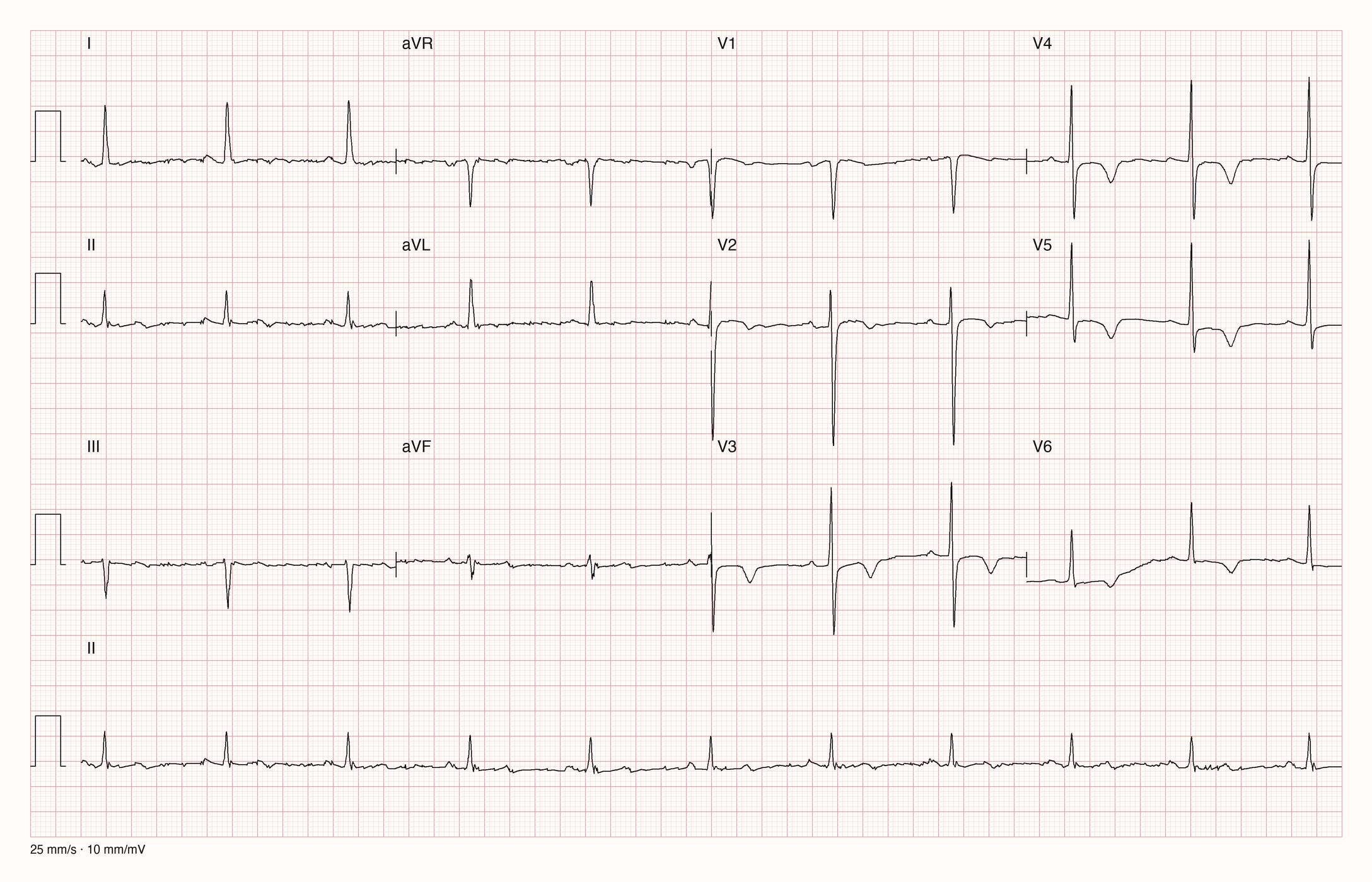 Reale EKG-Aufzeichnung mit zwölf Ableitungen; Aufnahme C03-U18-Q01; Skalierung im Bild