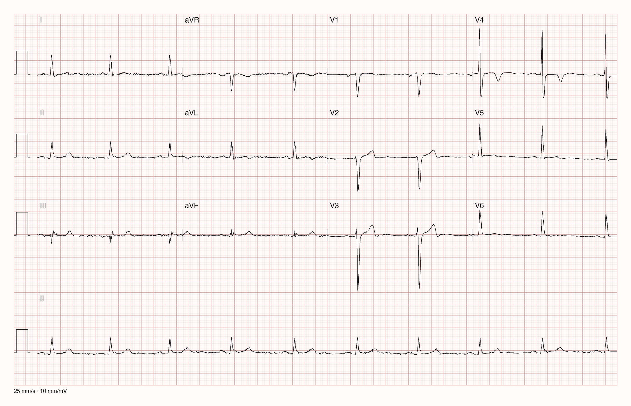 Reale EKG-Aufzeichnung mit zwölf Ableitungen; Aufnahme C03-U18-Q03; Skalierung im Bild