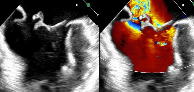 Transösophageales Echo, zwei Bilder nebeneinander: links Schwarz-Weiß-Schnitt der Mitralklappe mit einem in den Vorhof durchschlagenden Segelanteil, rechts derselbe Schnitt mit Farbdoppler und breitem rot-gelbem Rückstrom