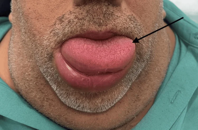 Untere Gesichtshälfte eines Mannes mit stark geschwollener Zunge, die zwischen den ebenfalls geschwollenen Lippen hervortritt; ein Pfeil zeigt auf die Zunge.