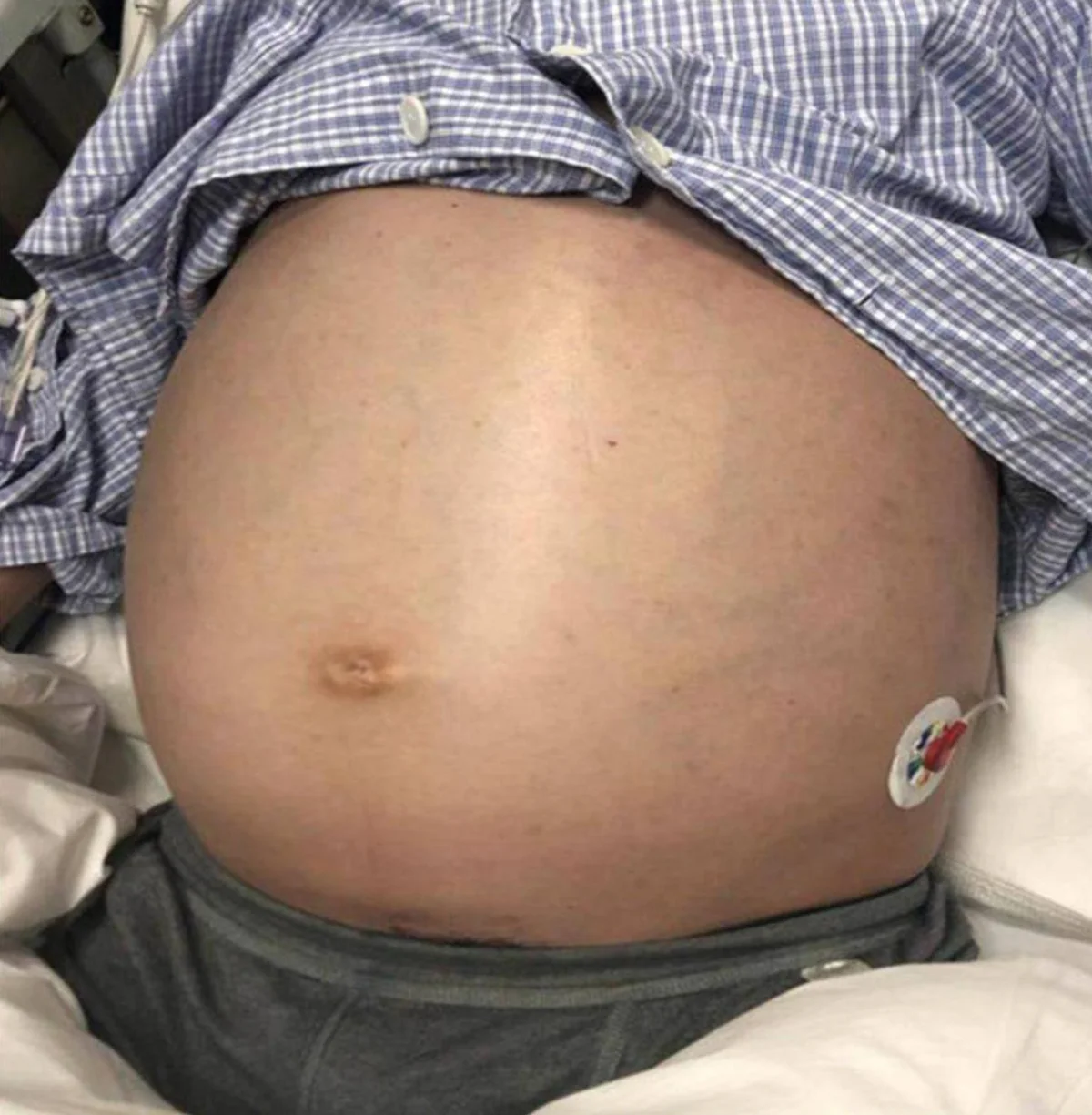 Stark vorgewölbtes, gespanntes Abdomen eines liegenden Mannes; seitlich eine EKG-Elektrode, oben das hochgeschobene Krankenhaushemd.