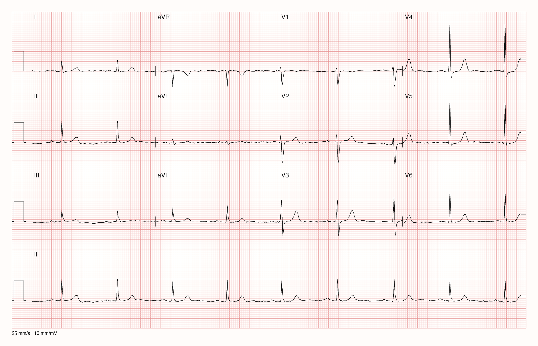Zwölfkanal-EKG mit regelmäßigem Sinusrhythmus um 54 pro Minute, einer P-Welle vor jedem QRS-Komplex und knapp verlängerter PQ-Zeit; unten ein Rhythmusstreifen der Ableitung II.