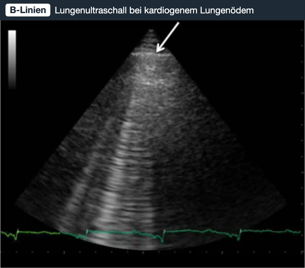 Lungenultraschall mit glatter, heller Pleuralinie oben (Pfeil) und mehreren hellen, senkrechten Artefaktbändern, die bis zum unteren Bildrand reichen.