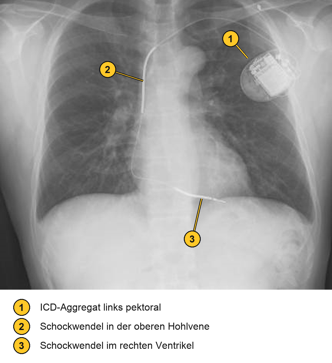 Thoraxaufnahme von vorn mit ICD-Aggregat links unter dem Schlüsselbein; eine Sonde zieht über die obere Hohlvene in den rechten Ventrikel und trägt zwei dicke, helle Abschnitte. Gelbe Nummern 1 bis 3 markieren Aggregat und beide Schockwendeln.