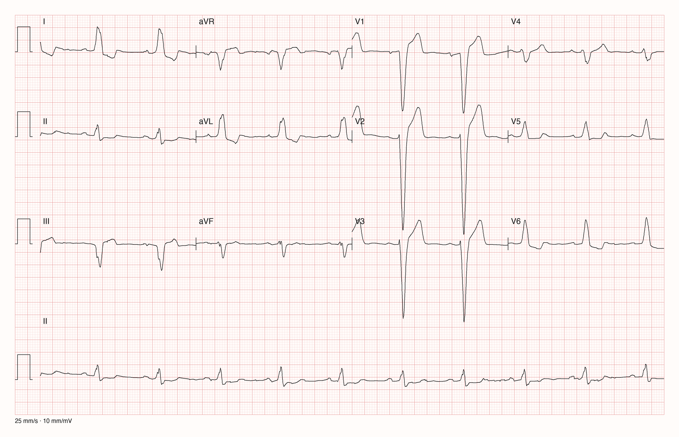 12-Kanal-EKG mit Sinusrhythmus und komplettem Linksschenkelblock.