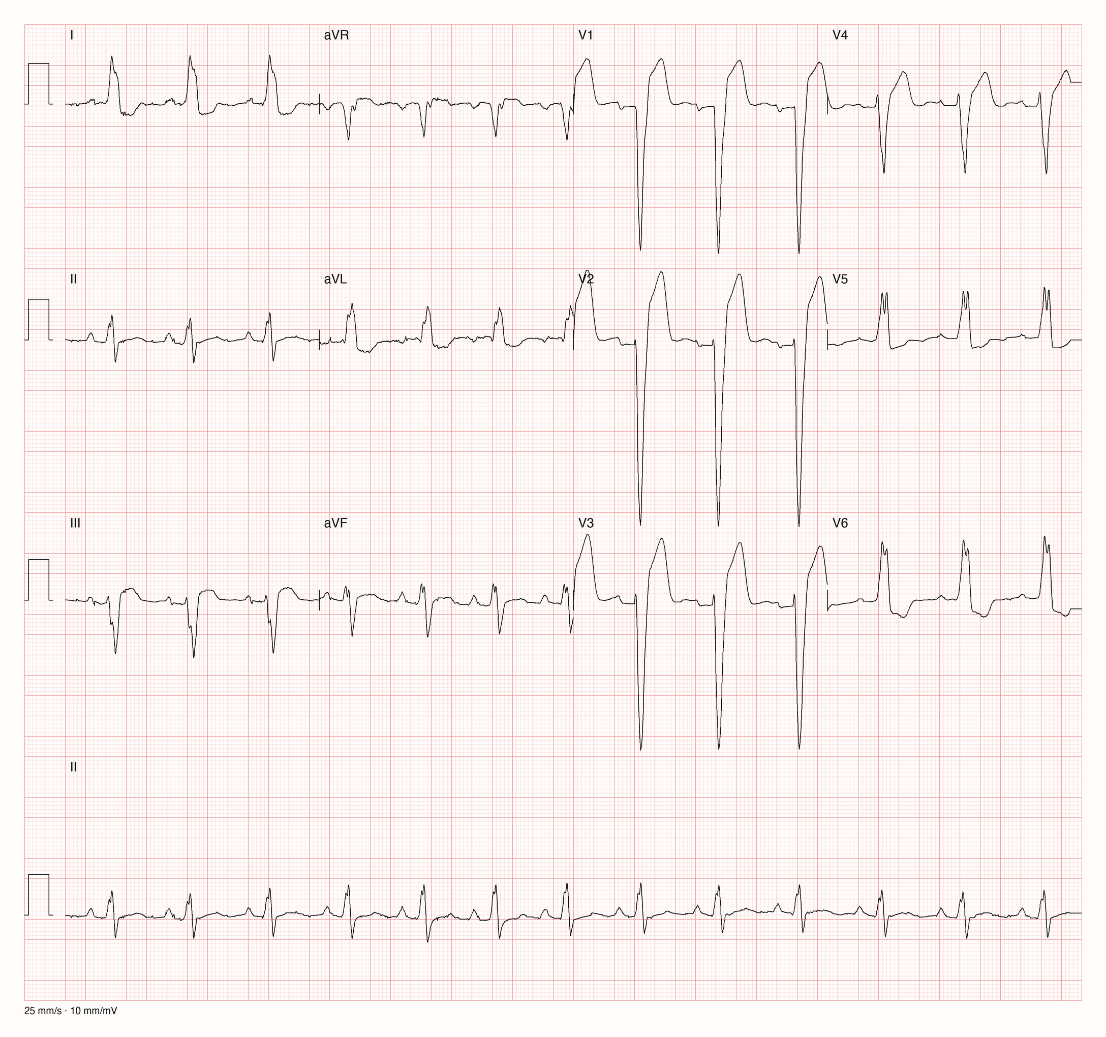 Zwölfkanal-EKG mit regelmäßigem Sinusrhythmus um 80 pro Minute und breiten QRS-Komplexen: in V1 bis V3 tiefe, breite negative Komplexe, in I, V5 und V6 breite, gekerbte positive Komplexe mit gegensinniger ST-Strecke; unten ein Rhythmusstreifen der Ableitung II.