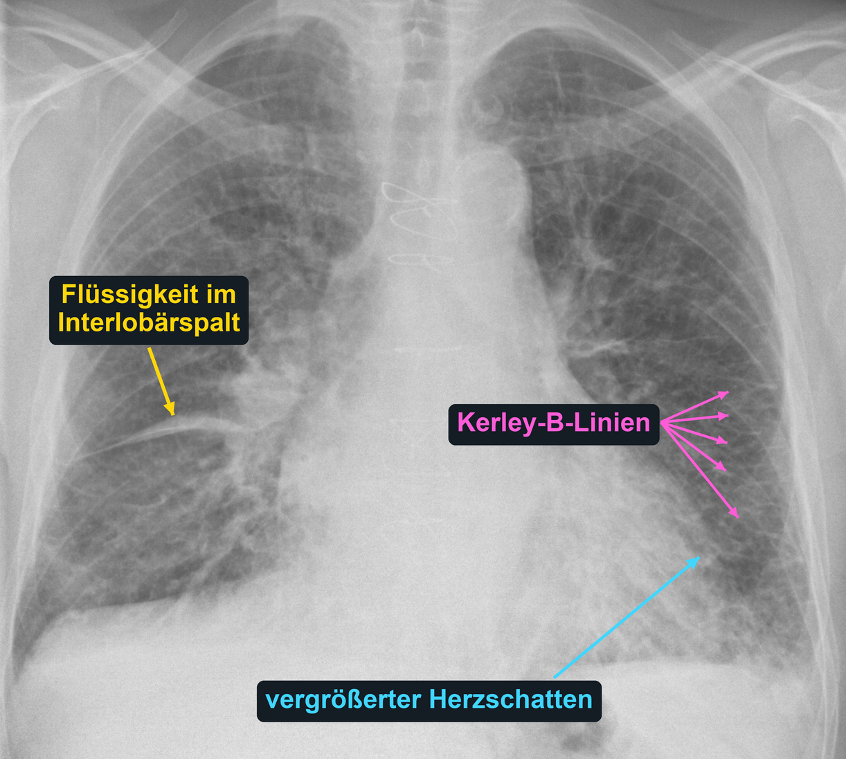 Thoraxaufnahme mit markierter Flüssigkeit im rechten Interlobärspalt, Kerley-B-Linien links basal und vergrößertem Herzschatten.