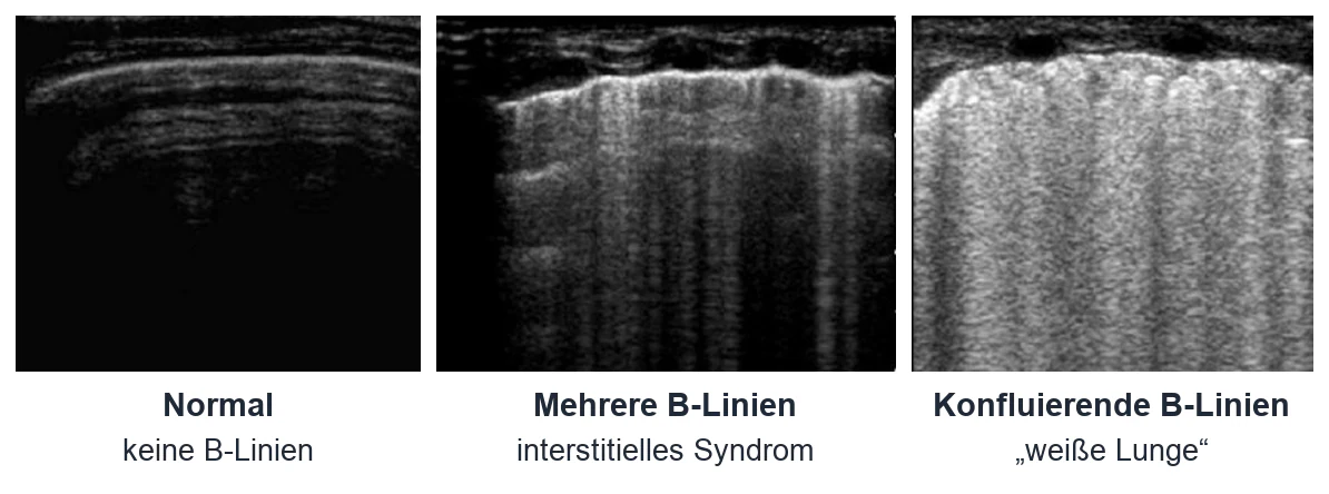 Lungenultraschall nebeneinander: links normale Lunge ohne senkrechte Streifen, Mitte mehrere helle senkrechte B-Linien, rechts konfluierende B-Linien als weiße Lunge.