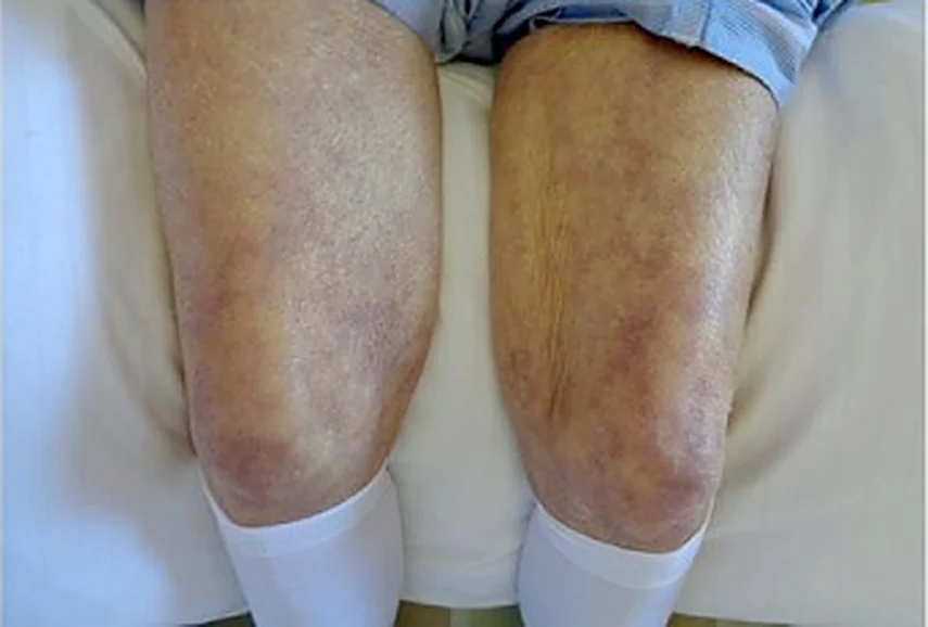 Beide Knie einer sitzenden Patientin mit fleckig-netzförmiger, livid-bläulicher Hautzeichnung; darunter weiße Strümpfe.