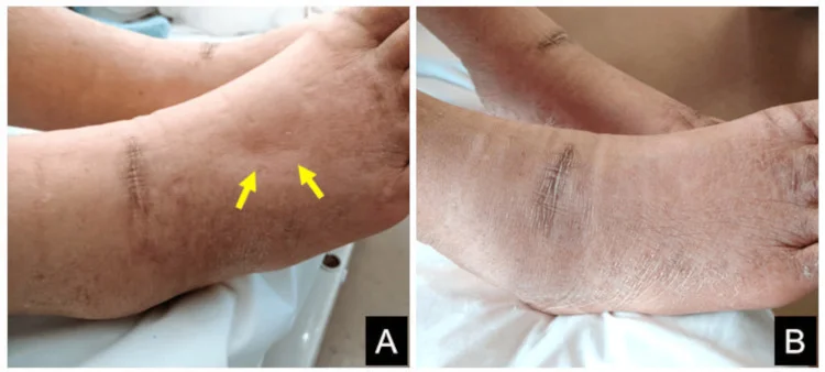 Rechter Fuß und Knöchel im Verlauf: links ausgeprägtes eindrückbares Ödem mit sichtbaren Dellen an den gelben Pfeilen, rechts derselbe Fuß sechs Tage später ohne sichtbares Ödem.