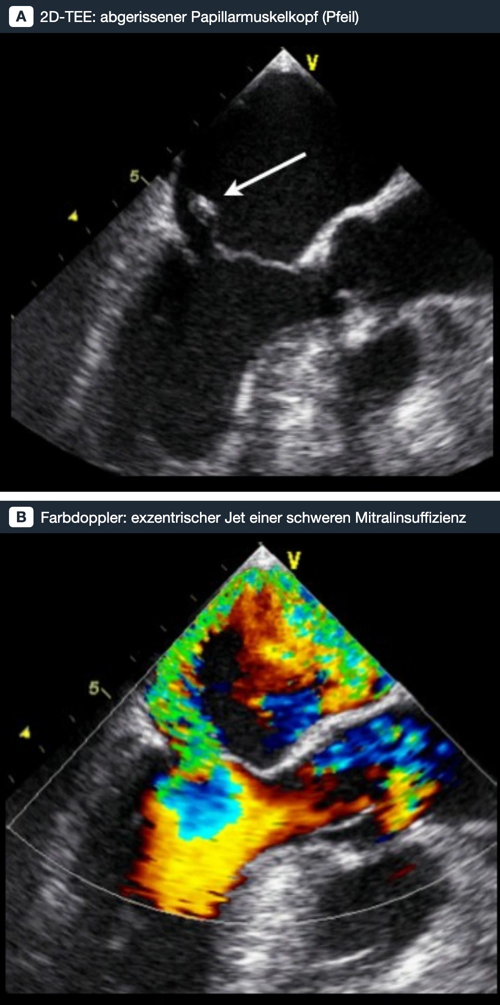 Zwei transösophageale Echobilder untereinander: oben ein abgerissener Papillarmuskelkopf am Mitralsegel (Pfeil), unten ein breiter, exzentrischer Farbdoppler-Jet in den linken Vorhof.