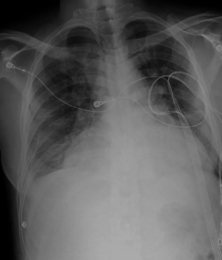 Röntgen-Thorax im Liegen von vorn mit EKG-Elektroden und Kabeln: stark verbreiterter Herzschatten, beidseits vermehrte, unscharfe Lungenzeichnung, vor allem um die Lungenwurzeln und in den unteren Feldern.