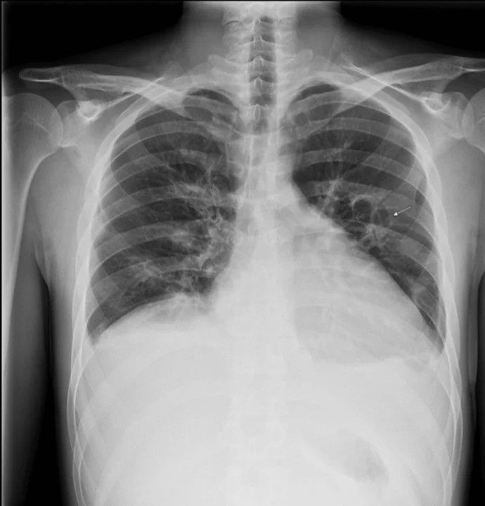 Röntgen-Thorax im Stehen von vorn: verbreiterter Herzschatten und beidseits vermehrte, netzartige Lungenzeichnung; ein kleiner weißer Pfeil aus der Originalabbildung liegt im linken Lungenfeld.
