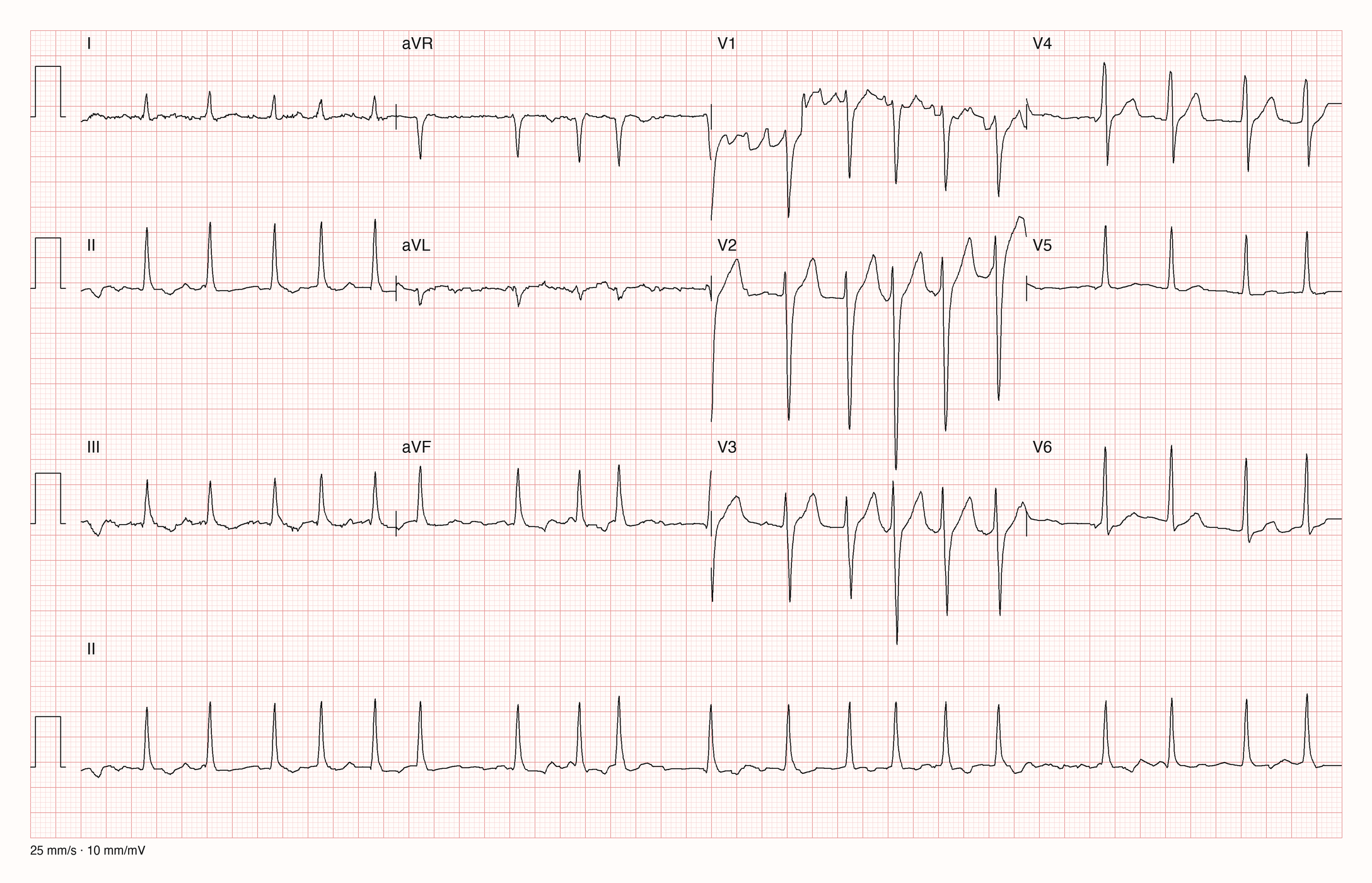 12-Kanal-EKG mit unregelmäßigen Abständen zwischen den QRS-Komplexen, ohne abgrenzbare P-Wellen, mit schmalen QRS-Komplexen und schneller Kammerfrequenz.