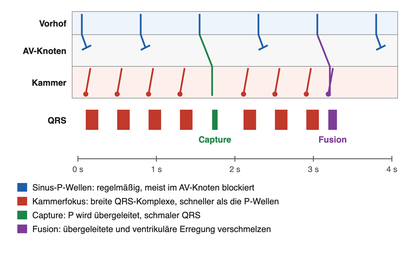 Leiterdiagramm mit Zeilen für Vorhof, AV-Knoten und Kammer: regelmäßige Sinus-P-Wellen, schnellere Kammerschläge, ein übergeleiteter schmaler Schlag und ein Mischschlag