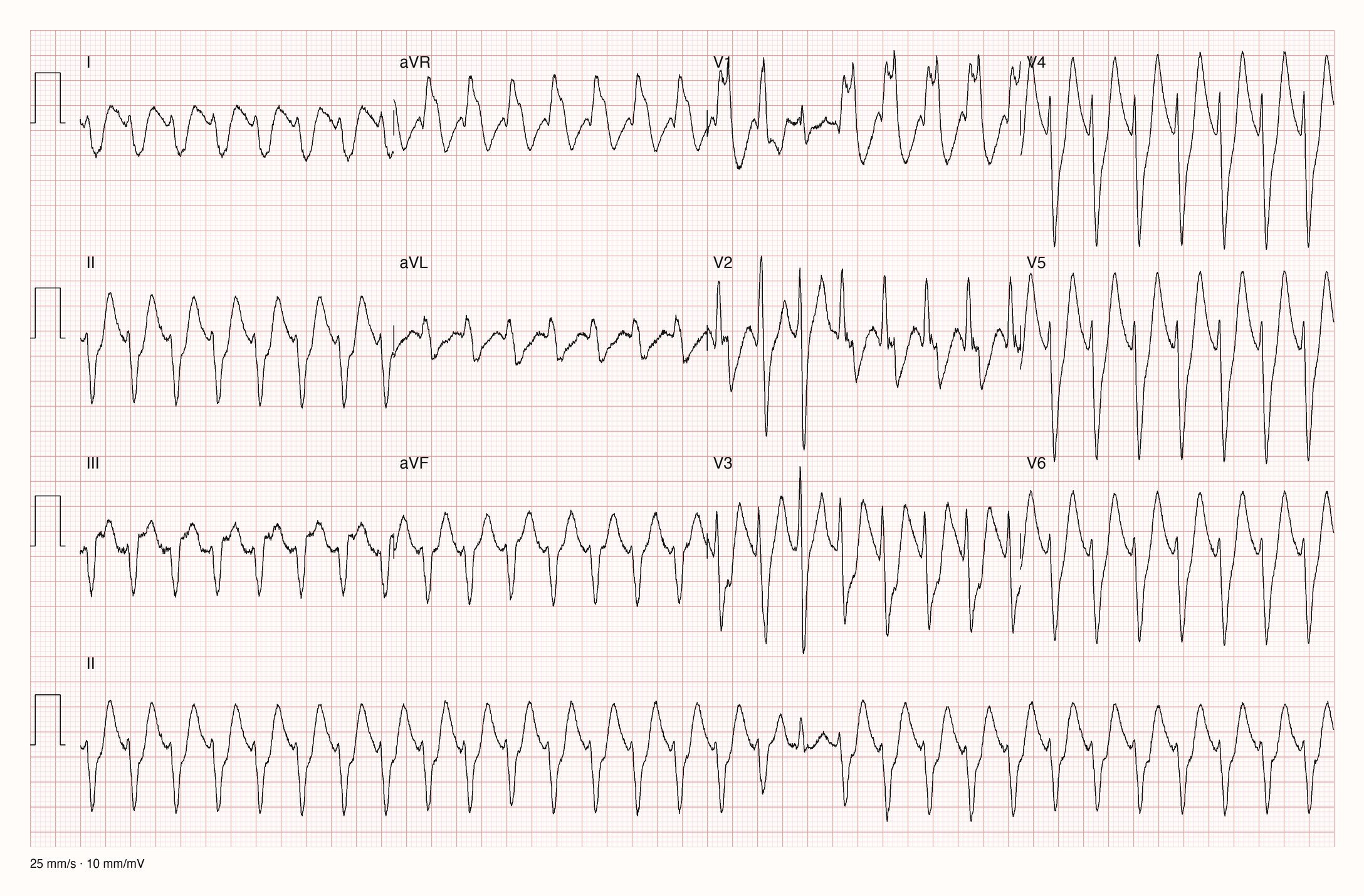 12-Kanal-EKG mit regelmäßiger Tachykardie und breiten QRS-Komplexen, im Rhythmusstreifen ein abweichender Schlag zwischen fünf und sechs Sekunden