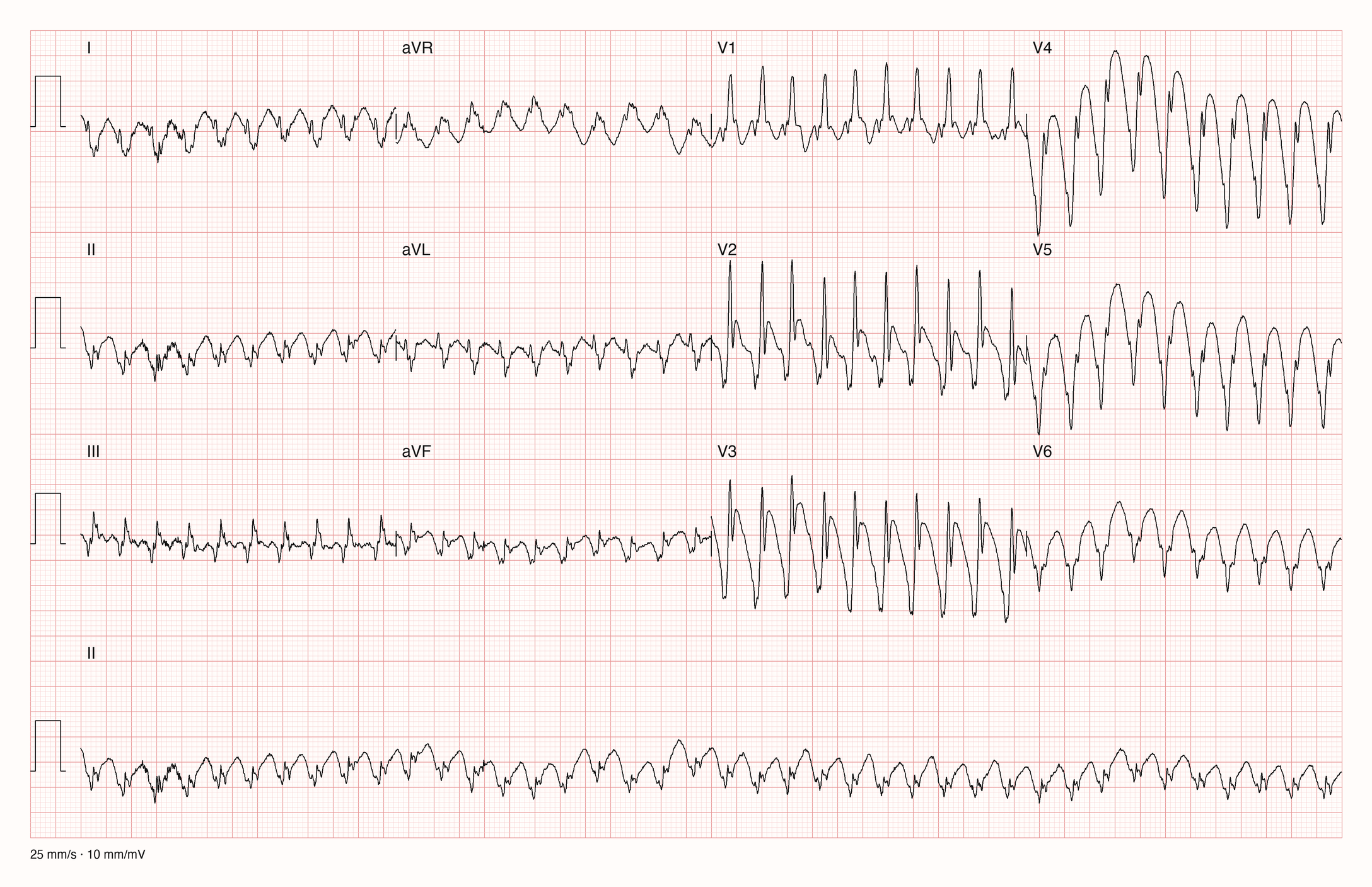 12-Kanal-EKG eines 51-jährigen Mannes mit sehr schneller Tachykardie