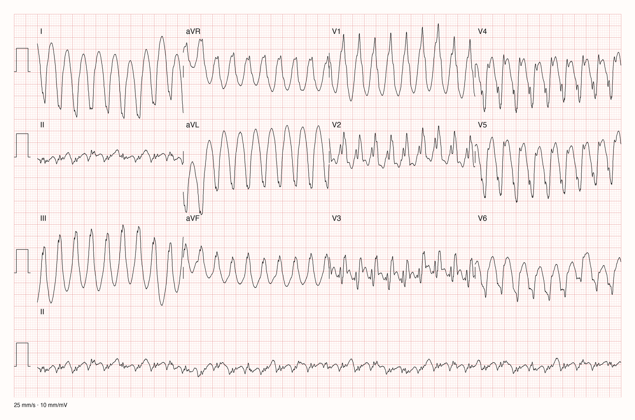 12-Kanal-EKG eines 48-jährigen Mannes mit sehr schneller, regelmäßiger Tachykardie und sehr breiten Ausschlägen
