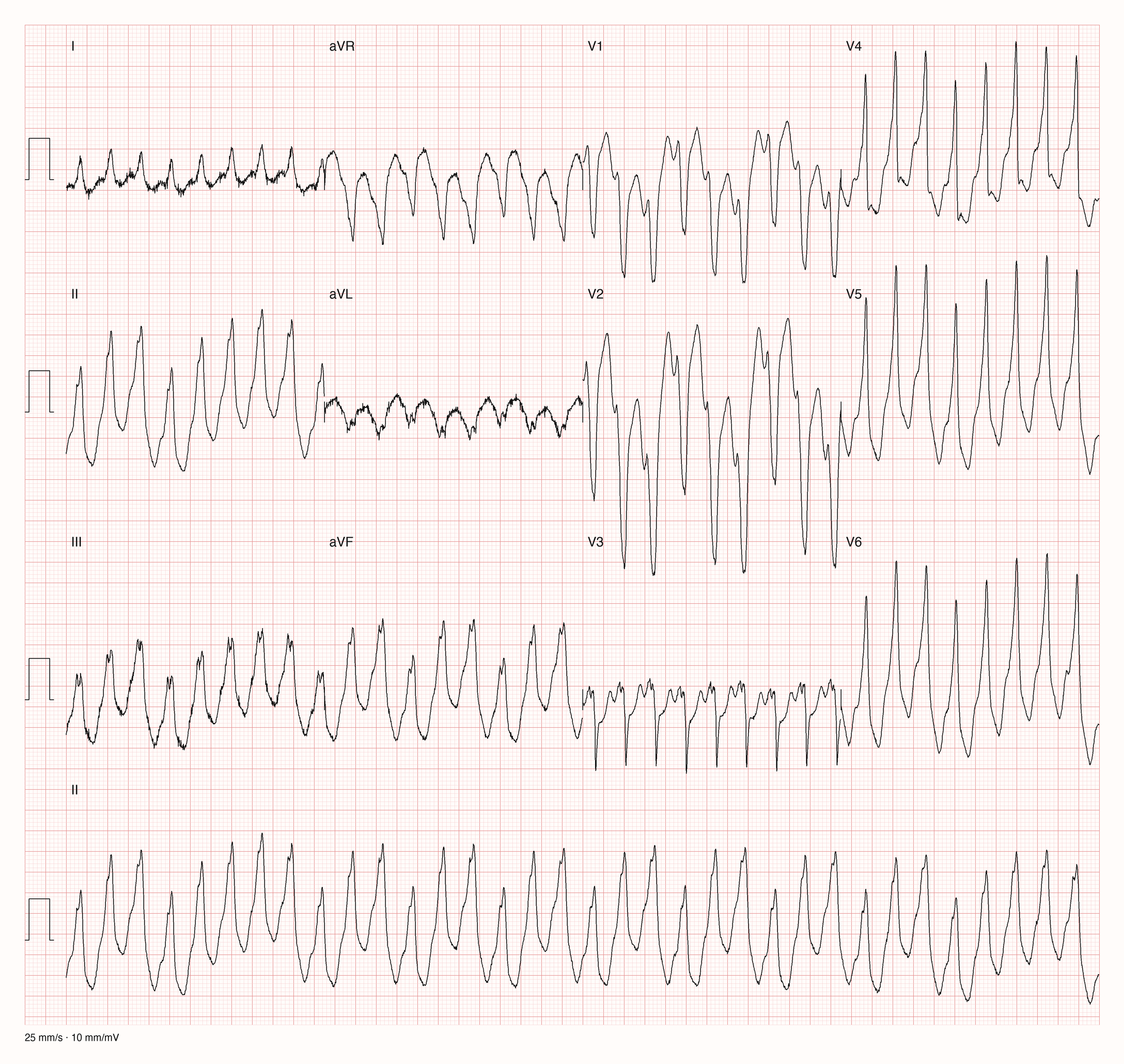 12-Kanal-EKG eines 63-jährigen Mannes mit regelmäßiger Tachykardie