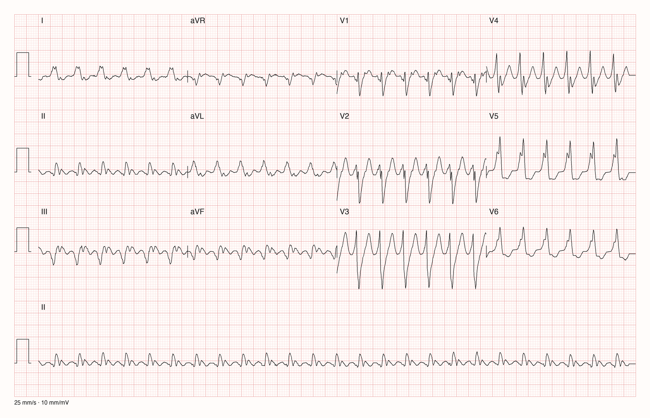 12-Kanal-EKG eines 71-jährigen Mannes mit regelmäßiger Tachykardie und breiten QRS-Komplexen