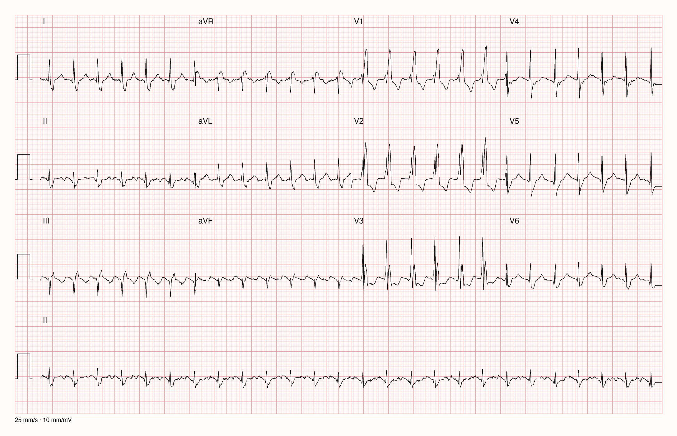 12-Kanal-EKG einer 77-jährigen Frau mit regelmäßiger Tachykardie und breiten QRS-Komplexen
