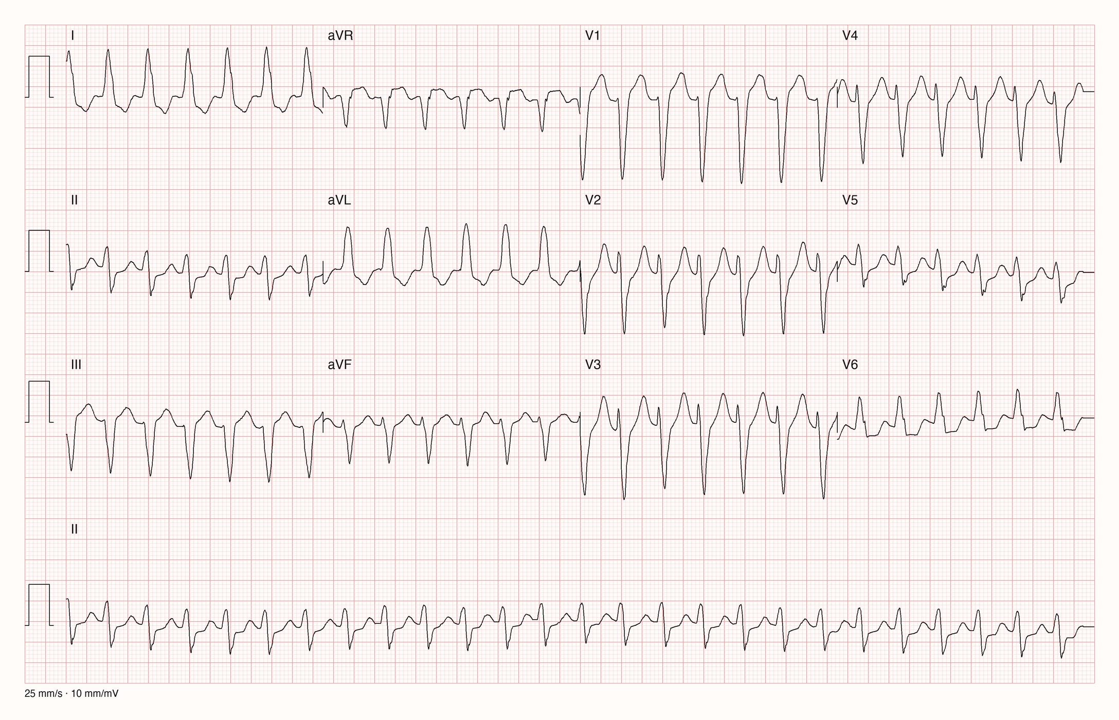 12-Kanal-EKG einer 83-jährigen Frau mit regelmäßiger Tachykardie und breiten QRS-Komplexen